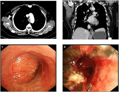 Case Report: ECMO-Assisted Uniportal Thoracoscopic Tracheal Tumor Resection and Tracheoplasty: A New Breakthrough Method